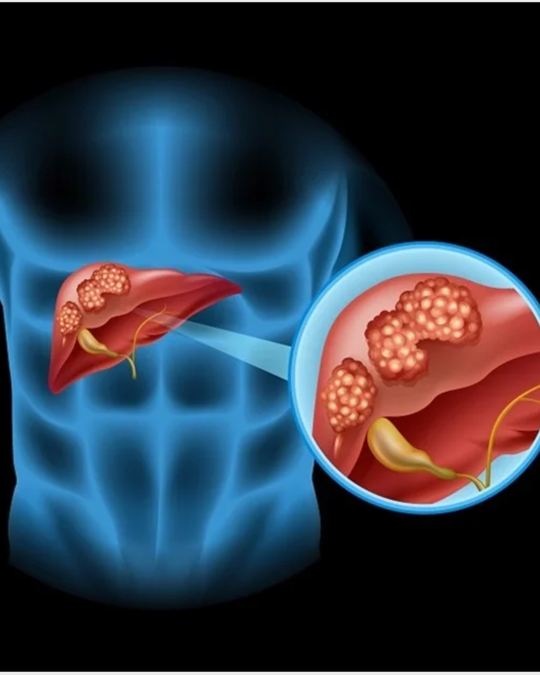 Liver Transplant Cost in India: A Comprehensive Guide