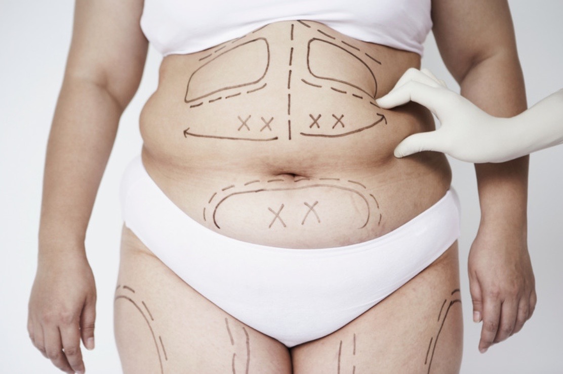 All about Liposuction: Your Guide to Body Contouring in India