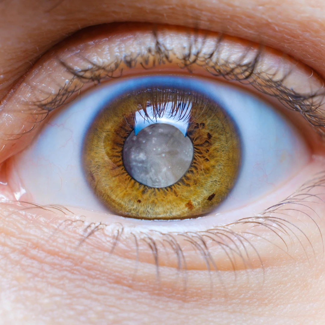 Things to Know Before Cataract Surgery